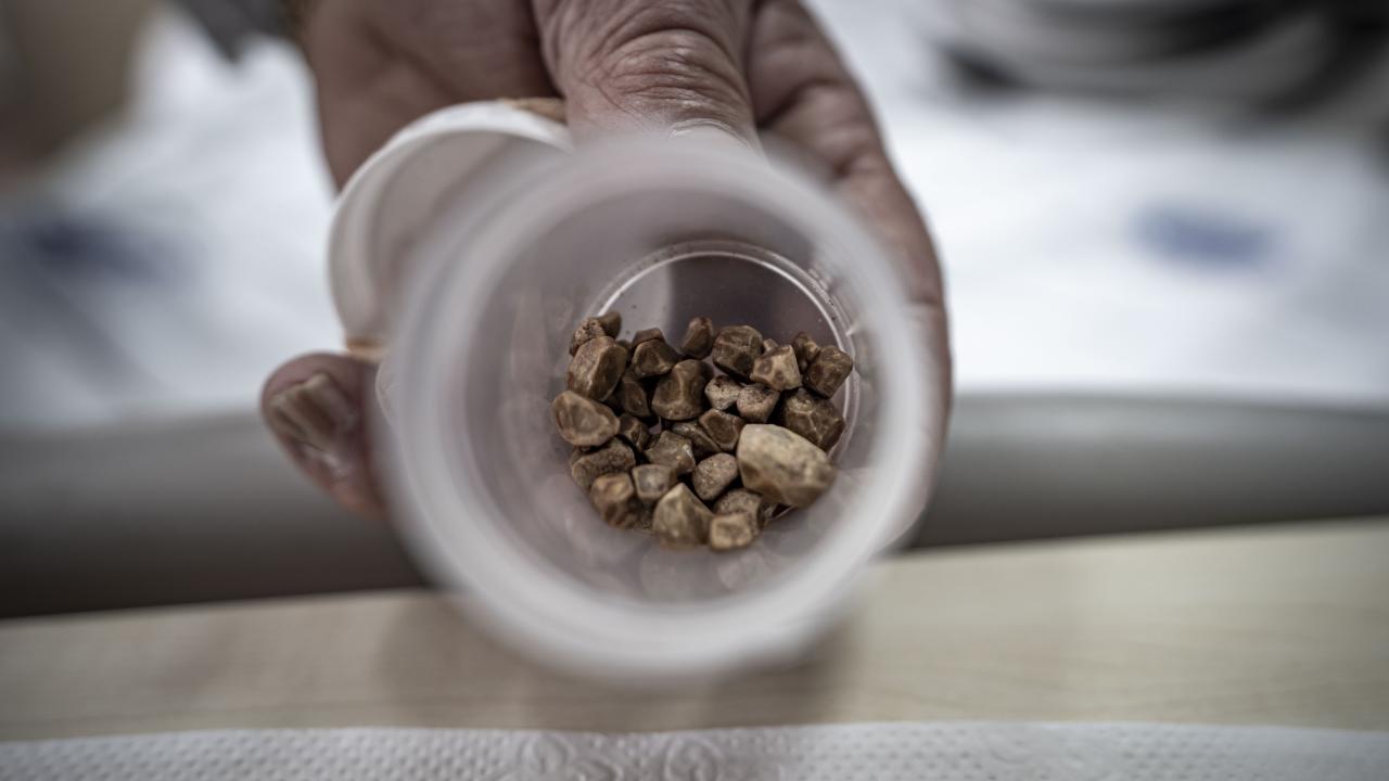 Doktorlar Bile Şaşkın! Kadının İdrar Kanalından Çıkan Taşlar Saymakla Bitmedi!