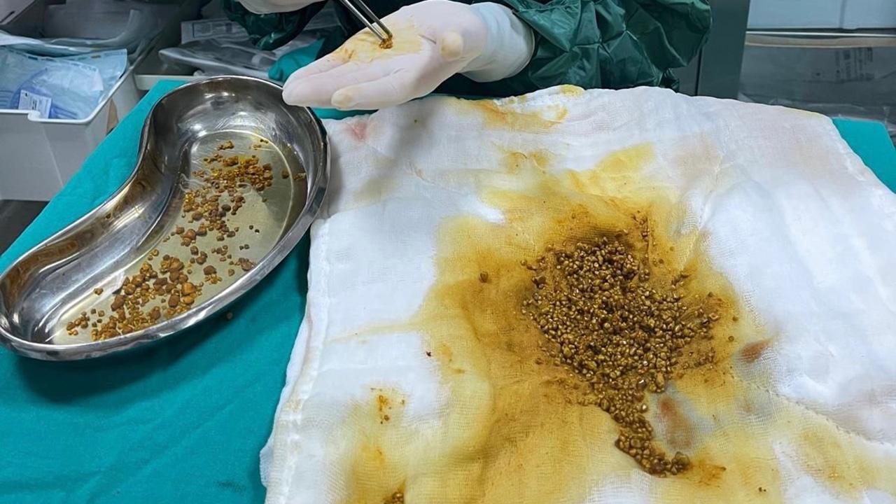 Doktorlar Bile Şaşkın! Safra Kesesinden Çıkan Taş Sayısı Rekor Kırdı!