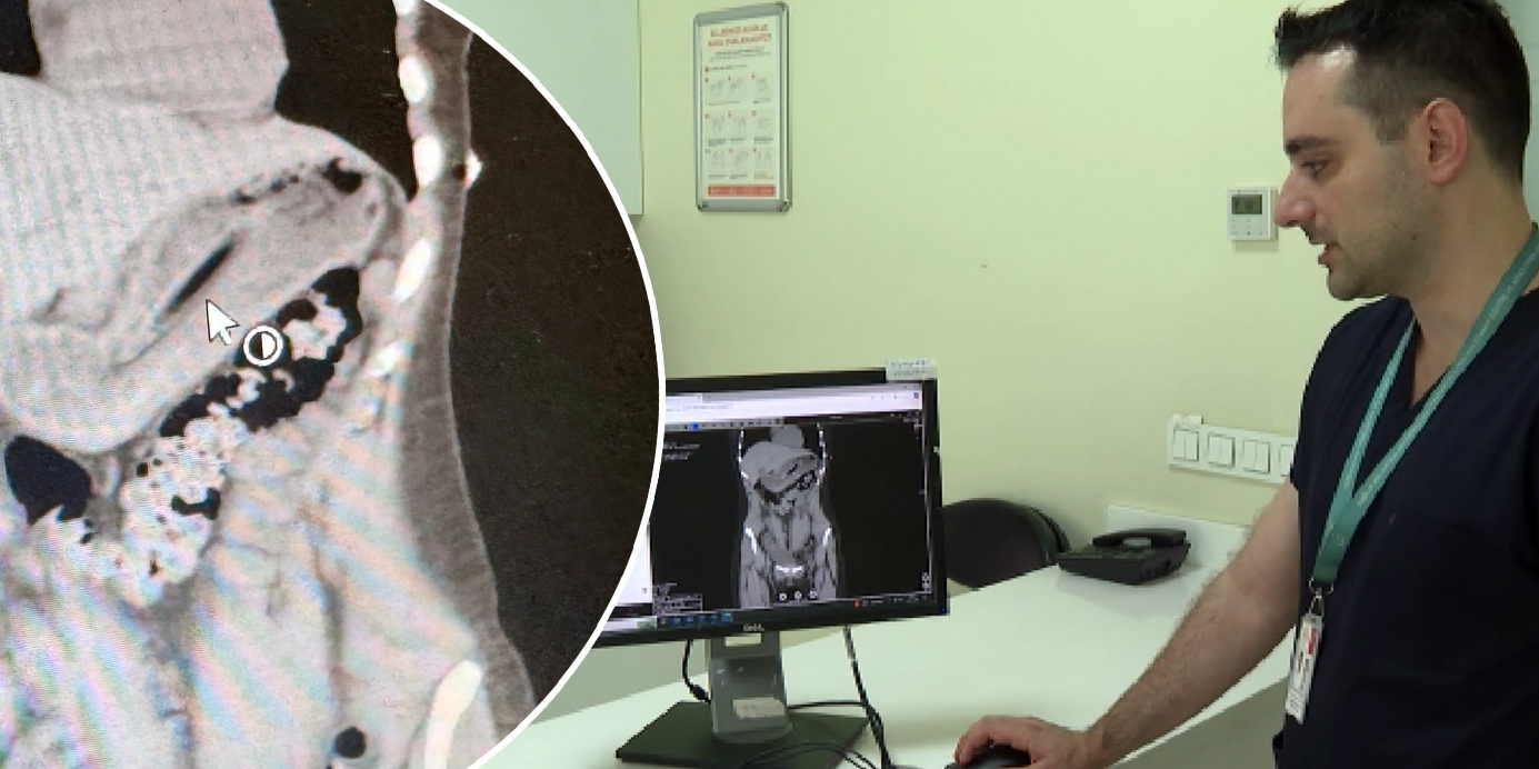 Zayıflama Yönteminde Tehlikeli Hata: Diş Fırçası Yutma Vakası